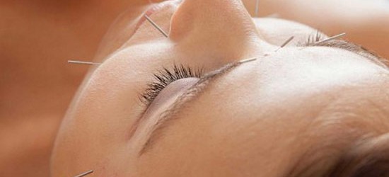 Facial acupuncture is a a pain-free alternative to plastic surgery